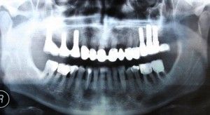  an age limit to implants? What guarantee do we have and what is the success   rate?  What is bone grafting associated with implants? How long does the 