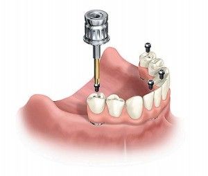 One day smiles, All on 4 Dental implants £500 and dental implants with abutment   and crown from £1200 by Evodental, the professional smile design centre 