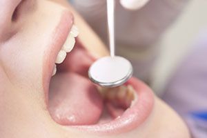 Your oral surgeon in Iowa City IA provide dental implants to their patients who    quick procedure involving manipulation of gum tissue and implant exposure.