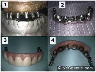A minimally invasive second-stage procedure for single-tooth implants. Bernhart   T, Haas R, Mailath G, Watzek G. Department of Oral Surgery, Dental School, 
