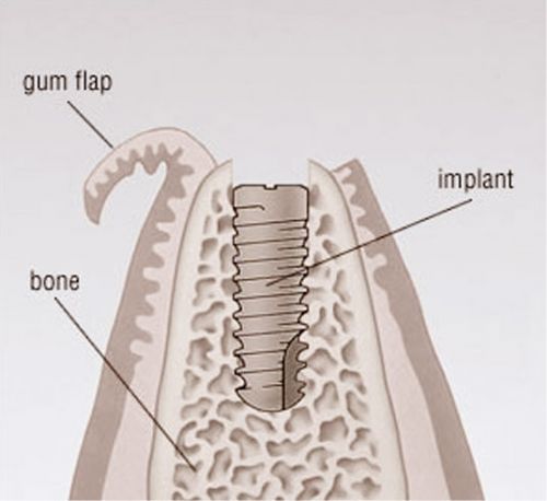 How long does the whole dental implant process take? . At this time, the top of   the implants will be uncovered from under the gums and a small metal post or 