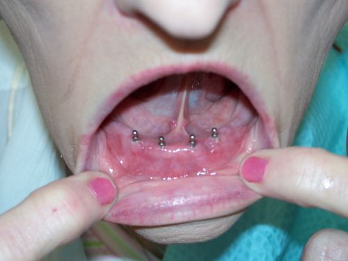 Mini dental implants are placed in a flapless and minimally invasive procedure   under local anesthetic. This is in sharp 