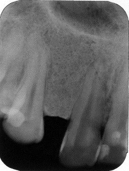 12 Apr 2007  Hi all, I had a root canal on my bottom left molar a few years ago.  Anyhow, she   suggested I get the tooth extracted and the implant put in all at the  seem to   have an implant put it a while after the tooth has been extracted.