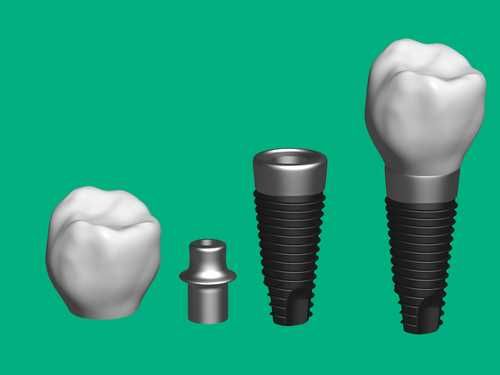 dental implant cost, $1,400 for the crown – as well as another $600 for a custom   abutment. “I never seem to cover the lab fees well enough,” sighed one dentist.