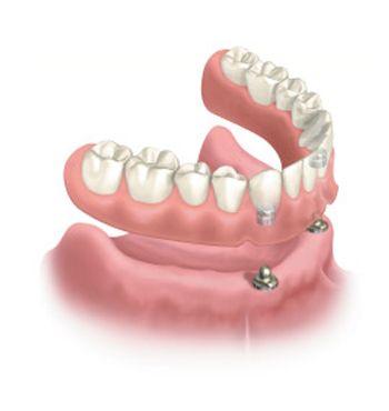 The two types of dental implant supported dentures are the bar-retained and    Bar-retained dentures will require a minimum of three dental implants implants 