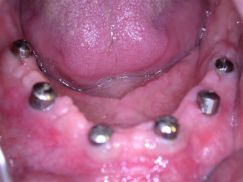 When Is This Used? Single-tooth implants can be used in people who are   missing one or more teeth. . A. Healing after second-stage surgery. A collar,   called a 