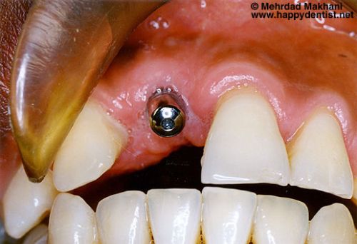 A Straumann-brand root-form endosseous dental implant placed in the site of the   . Proponents of 'flapless' surgery believe that it decreases recovery time while   its . a short implant can be placed and to not expect a long period of usability.