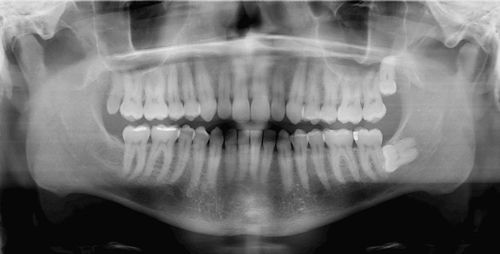 15 Sep 2011  Like many medical procedures, dental X-rays have an upside and a  "My   brother-in-law is a radiologist, and he's told me that radiation is 