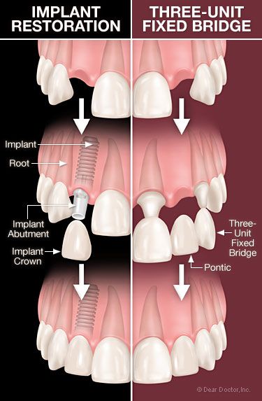 Pros And Cons Of Dental Implants Vs Bridges Find Local Dentist Near Your Area