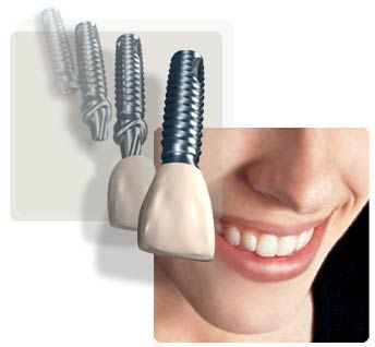 Dental Implants are small titanium posts which are placed in the jawbone and   used to  These additional costs push the average for a fully restored implant to 