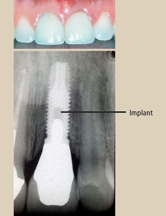 Affordable Dental Implants. Why we are Affordable? Dental implant treatment can   be very expensive. The expense to doctors to provide the service is constantly 