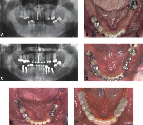 A total of 53 dental implants (ITI-Straumann) was placed, 12 in the maxilla, 41 in   the mandible. The prosthetic rehabilitation consisted of overdenture therapy in 