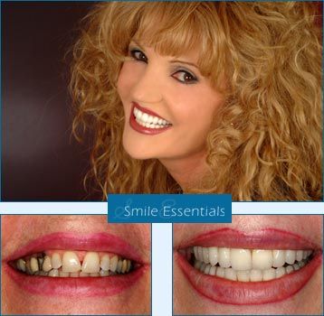 Dental implants are fixed titanium posts that act as teeth roots and are used to   permanently replace missing teeth. Read More ». Average Price: $8,375 
