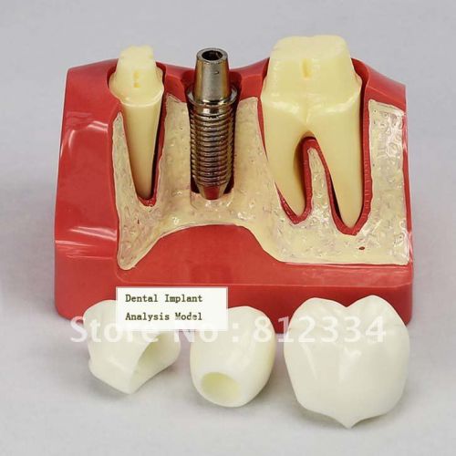 Dental Implants Brands In Usa Find Local Dentist Near Your Area
