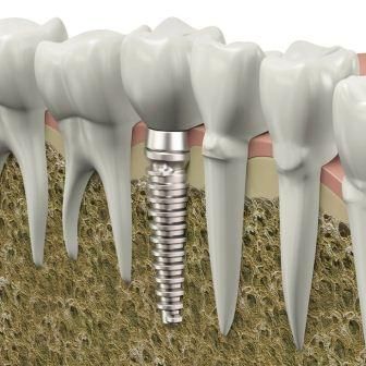 The best dental implants are manufactured to very strict tolerances such as   airplane engines would be  95%— skill of the surgeon and quality of the final   teeth.