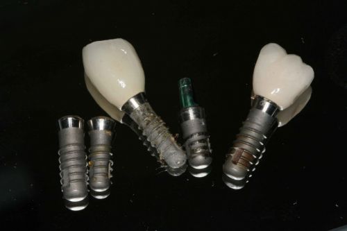 31 Oct 2011  What's up with $399 Dental Implants? (Above: failed implants referred to our   office for removalall implant knock-offs). Squeezed between 