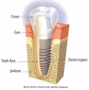 Definition of a bad day can be going to the dentist, and they inform you that you   need an implant, or worse multiple. Next they tell you that it will cost you about 
