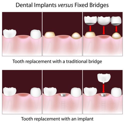 2 Dec 2011  Scroll down to get an idea about dental implants average cost.  The dental   implant procedure makes use of titanium screws that are fitted into 
