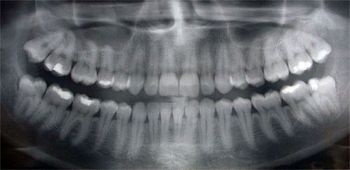 Dental x-rays allow a dentist to detect dental cavities and other pathologies that   otherwise would go unseen. X-rays are quite safe, and the potential benefits far 