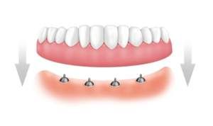 Dental implants allow for the attachment of a non-removable denture that   functions like natural teeth and they do not  Before Implant Retained Bar   Denture 