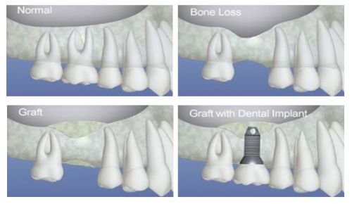 In this section, are stories and photo galleries of patients treated over the years   who required bone grafting for dental implants. Long term success of implants 