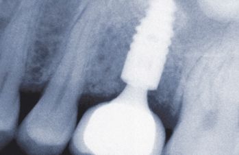 Ian asks: I have 2 missing #29 #30 right lower jaw. Oral surgeon seeing the x-ray   film and exam suggested I get 2 dental implants plus bone-graft as the width is 