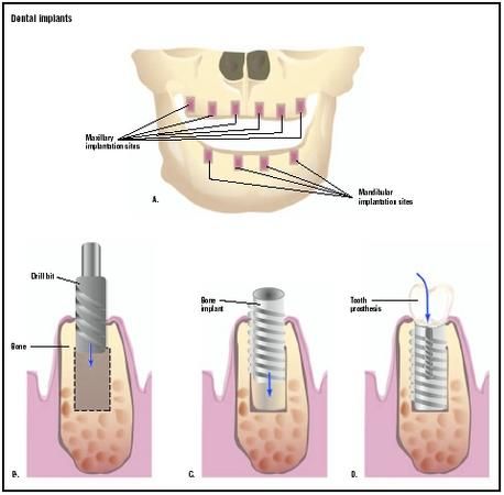 In this procedure, your dentist can place the implants, and place a temporary   crown or bridge all in one visit. The time frame for this one-stage procedure, from 