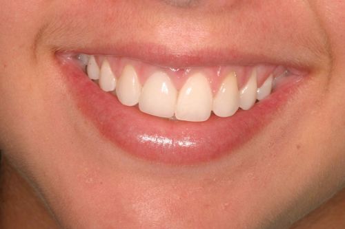 Before & After Photos of actual dental treatment 
