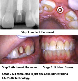 Dental Implant “Overdenture” Basics – Dr. Ramsey Amin, Burbank, CA →  The   lower jaw is usually very dense which speeds up the time frame.  The   procedure chosen depends on several factors, such as your health, the number   of teeth 