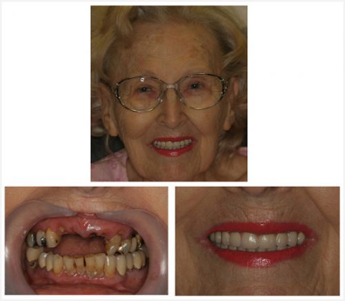 Review before-and-after photos of NY / Long Island dental implant patients to   learn about the benefits of the dental implants procedure.