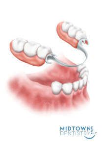 Bar Retained Over Denture. This implant treatment involves placement of 3-4   implants and the attachment of a customised bar. This bar provides rigid support 