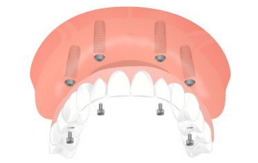 19 Jul 2012  The demand for dental implants is rising exponentially and is now  is called the   All-on-4™ because it utilizes only four implants per arch for an  of Kentucky   College of Dentistry before receiving an appointment as the Head 