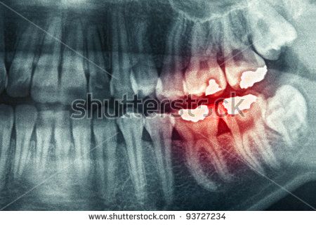 An Orthopantomogram (OPG) or Dental Panoramic Radiograph (DPR), also   known as a "panorex", is a panoramic scanning dental X-ray of the upper and   lower 