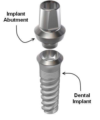 Firstly, are you saying that when an implant crown fails the cost of replacing  is   the abutment and with a normal crown its the underlying tooth.
