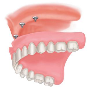 29 Dec 2011  Suffering from you upper denture moving around or gagging you? Then consider   mini dental implants if you have lost some bone and can't 