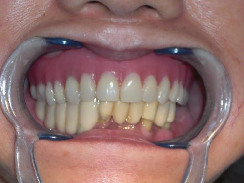14 Jan 2012  This case is of a person who started off with an ill-fitting upper denture that was   stabilized with mini dental implants and without palate coverage 