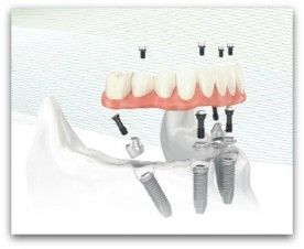 7 Feb 2012  Best prices for all 4 one on Dental Implants. All 4 one Dental Implants, or the   more common name, All on 4 Dental implants, are based on having .. 1 Arden   Building, Station Road, Dorridge, Solihull, Birmingham, B93 8HH 