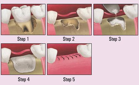 A Free guide to Dental Bone grafting, costs, risks and the surgery involved.  In   order for a dental implant to be successful the patient must have sufficient bone in   the  Alloplastic grafts – these grafts are man made from synthetic materials, 