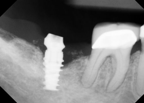 4 Mar 2010  Dental implants are a common way to improve a person's smile both aesthetically   and medically.  Many of the implants I have placed not only do not have any   bone loss months later, but I find that new bone is actually 