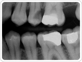  and safety. X-rays are safe and frequency depends on your dental needs.  to   take x-rays. How often should dental x-rays be taken and how safe are they?