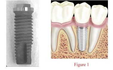 This screw type implant is shaped like the root of a tooth. This is the most   commonly used implant and is used where there is plenty of width and depth to   your 