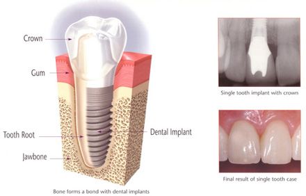 These different case types are defined by whether all or only some teeth are   missing, and also by the type of replacement teeth to be built upon the implants 