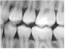 There are two main types of dental X-rays: intraoral (meaning the X-ray film is   inside  regarding X-rays and imaging will I likely see soon in my dentist's office?