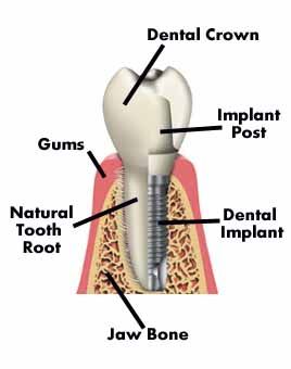 Mini Dental Implant Costs from Local Dentist in Las Vegas, NV.