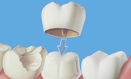 After fully discussing the benefits and risks, you may also want to contact your   dental insurance provider to verify whether implant placement and restoration is 