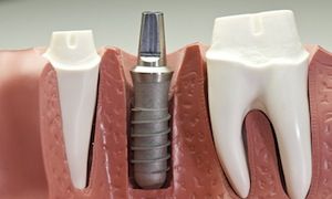 Why are my teeth sensitive? Sensitive teeth are often caused by cavities or gum   recession.  How Much Does a Dental Implant Cost? Fees from Dental Implants 