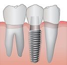 Dental implants in Raleigh, NC have fast become the preferred way to replace   one or more missing teeth, or anchor a denture or bridge. Call us to learn more.