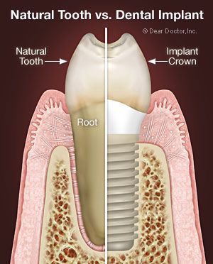 What Are The Types of Dental Implants? There are many implants available,   each  There are two methods for its placement. The "dual surgery" method.