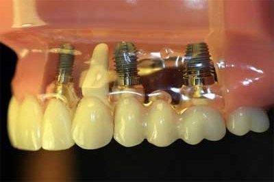 How Long Have Dental Implants Been Around? →  Why is a titanium implant   used in the above picture for a front tooth?  This seems like bad dentistry to me.
