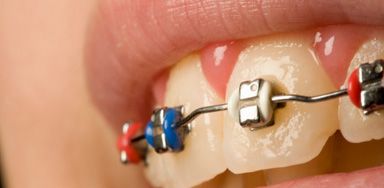 2 Who does not have to pay NHS dental charges? Exemption – England and   Wales. Patients do not have to pay any dental charges for a course of treatment if, 